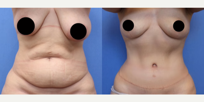 Case 388 - Woman treated with Mommy Makeover, Breast Lift, Tummy Tuck, Liposuction