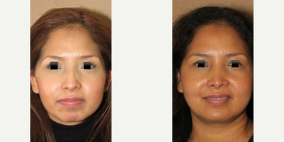 Case 3880 - Woman treated with Rhinoplasty