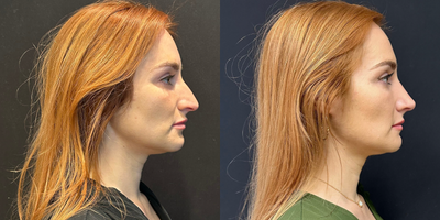 Case 3881 - Woman treated with Rhinoplasty