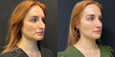 Case 3882 - Woman treated with Rhinoplasty