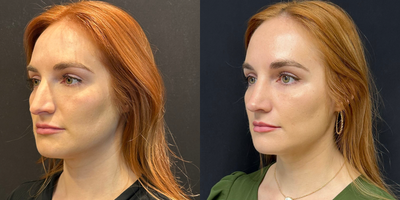 Case 3883 - Woman treated with Rhinoplasty