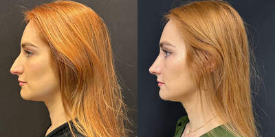 Case 3884 - Woman treated with Rhinoplasty