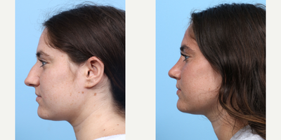 Case 3885 - 18-24 year old woman treated with Rhinoplasty