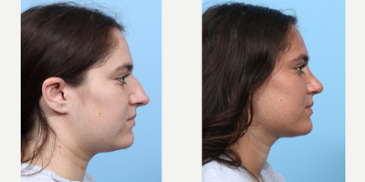 Case 3886 - 18-24 year old woman treated with Rhinoplasty