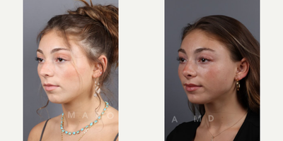 Case 3887 - Woman treated with Rhinoplasty, Septoplasty