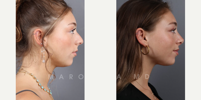 Case 3889 - Woman treated with Rhinoplasty, Septoplasty