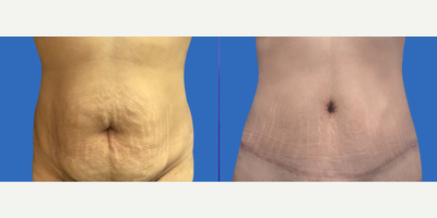 Case 389 - 29 year old woman treated with Tummy Tuck