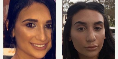 Case 3890 - Woman treated with Rhinoplasty