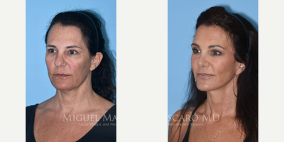 Case 3892 - Woman treated with Rhinoplasty