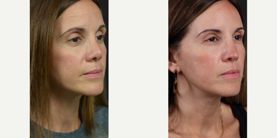 Case 3897 - Woman treated with Rhinoplasty