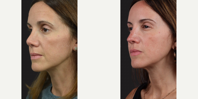 Case 3898 - Woman treated with Rhinoplasty