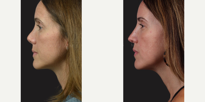 Case 3899 - Woman treated with Rhinoplasty