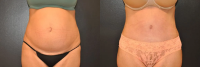 Case 39 - Woman treated with Tummy Tuck