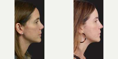 Case 3900 - Woman treated with Rhinoplasty