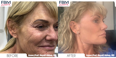Case 3901 - 45-54 year old woman treated with Deep Plane Facelift, Neck Lift, Forehead Reduction, Double Eyelid Surgery, Rhinoplasty, Facial