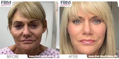 Case 3902 - 45-54 year old woman treated with Deep Plane Facelift, Neck Lift, Forehead Reduction, Double Eyelid Surgery, Rhinoplasty, Facial
