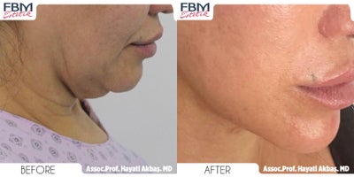 Case 3903 - 45-54 year old woman treated with Deep Plane Facelift, Neck Lift, Rhinoplasty, Lip Lift, Canthoplasty, Eyelid Surgery, Facial Fa