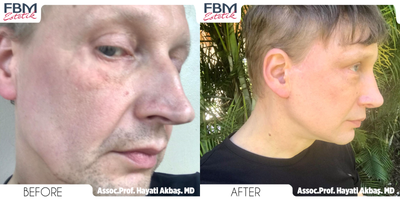 Case 3904 - 45-54 year old gender nonconforming person treated with Deep Plane Facelift, Eyelid Surgery, Neck Lift, Facial Fat Transfer, Rhi