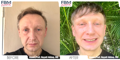 Case 3905 - 45-54 year old gender nonconforming person treated with Deep Plane Facelift, Eyelid Surgery, Neck Lift, Facial Fat Transfer, Rhi