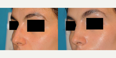 Case 3906 - Woman treated with Rhinoplasty