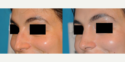 Case 3907 - Woman treated with Rhinoplasty