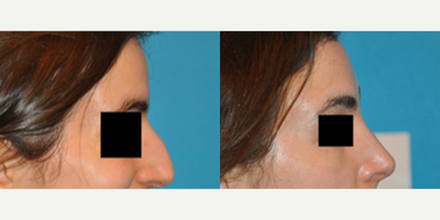 Case 3908 - Woman treated with Rhinoplasty