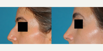 Case 3909 - Woman treated with Rhinoplasty