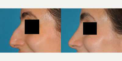 Case 3910 - Woman treated with Rhinoplasty