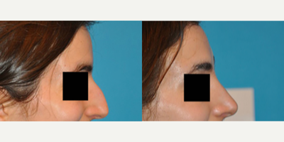 Case 3911 - Woman treated with Rhinoplasty
