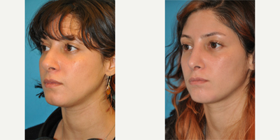 Case 3912 - Woman treated with Rhinoplasty