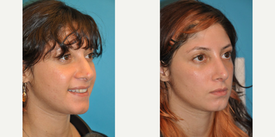 Case 3913 - Woman treated with Rhinoplasty