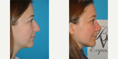 Case 3914 - Woman treated with Rhinoplasty