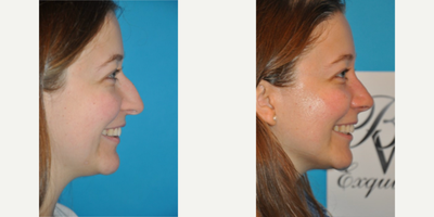 Case 3915 - Woman treated with Rhinoplasty