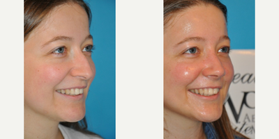 Case 3916 - Woman treated with Rhinoplasty