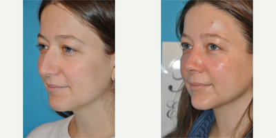 Case 3917 - Woman treated with Rhinoplasty