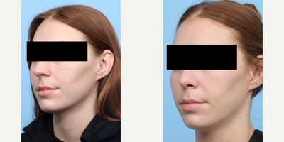 Case 3918 - 25-34 year old gender nonconforming person treated with Rhinoplasty