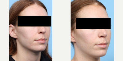 Case 3919 - 25-34 year old gender nonconforming person treated with Rhinoplasty