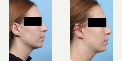Case 3920 - 25-34 year old gender nonconforming person treated with Rhinoplasty