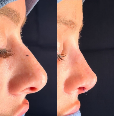 Case 3921 - Woman treated with Rhinoplasty