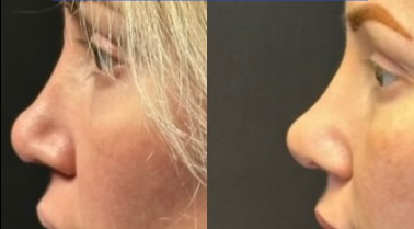 Case 3922 - Woman treated with Rhinoplasty