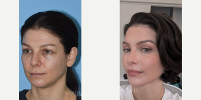 Case 3923 - Woman treated with Rhinoplasty