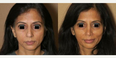 Case 3924 - Woman treated with Rhinoplasty