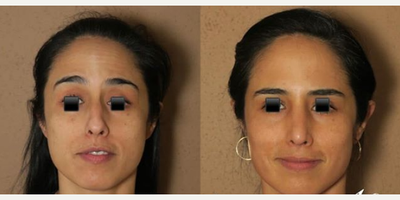 Case 3925 - Woman treated with Rhinoplasty