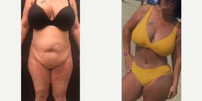 Case 393 - 35-44 year old woman treated with Tummy Tuck, Liposuction, Mommy Makeover