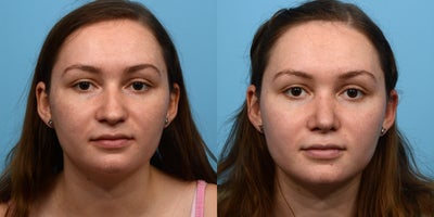 Case 3935 - 18-24 year old woman treated with Rhinoplasty