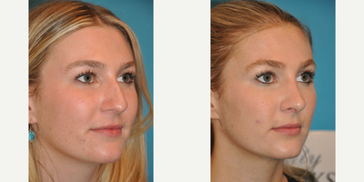 Case 3936 - Woman treated with Rhinoplasty