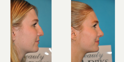 Case 3937 - Woman treated with Rhinoplasty