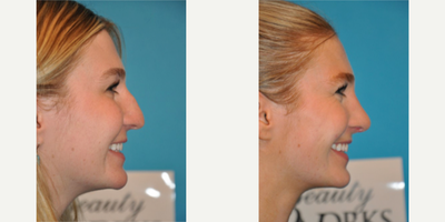 Case 3938 - Woman treated with Rhinoplasty