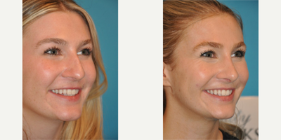 Case 3939 - Woman treated with Rhinoplasty