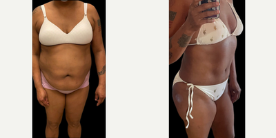 Case 394 - 45-54 year old woman treated with Tummy Tuck, Liposuction, Mommy Makeover